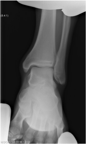 Syndesmosis stress view